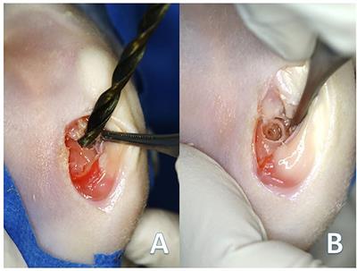 Intra-osseous infiltration of adipose mesenchymal stromal cells and plasma rich in growth factors to treat acute full depth cartilage defects in a rabbit model: Serum osteoarthritis biomarkers and macroscopical assessment